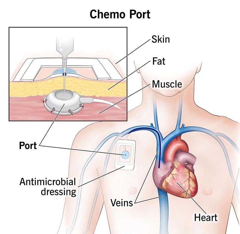 chemo-port.jpg