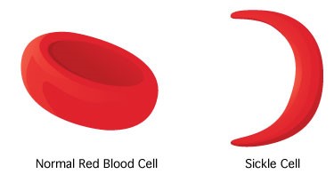 sickleCell vs normal REV.jpg