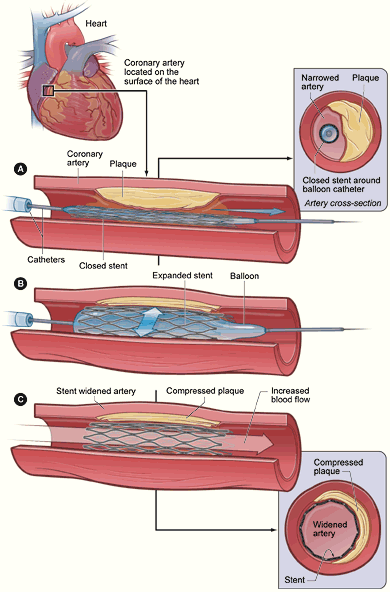 Coronary angioplasty.gif