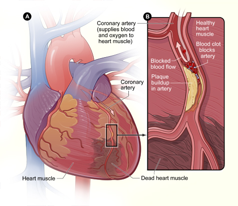 Coronary artery disease.jpg