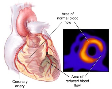 Nuclear scan for coronary disease.jpg