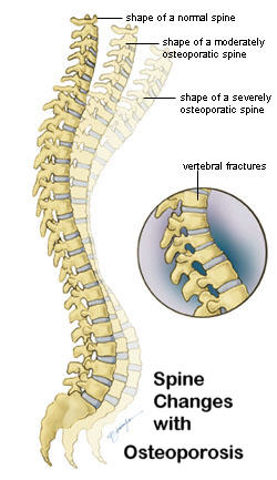 Spine changes with osteoporosis.jpg
