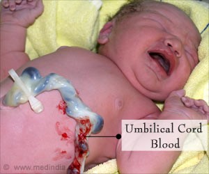 Umbilical Cord blood _ Stem cell.jpg