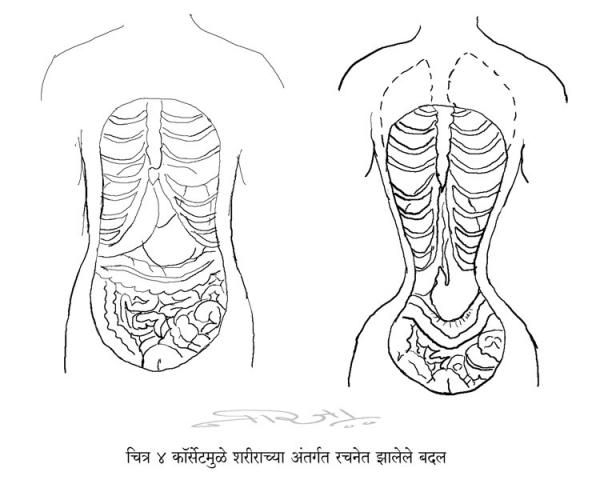 04-corset-damage.jpg